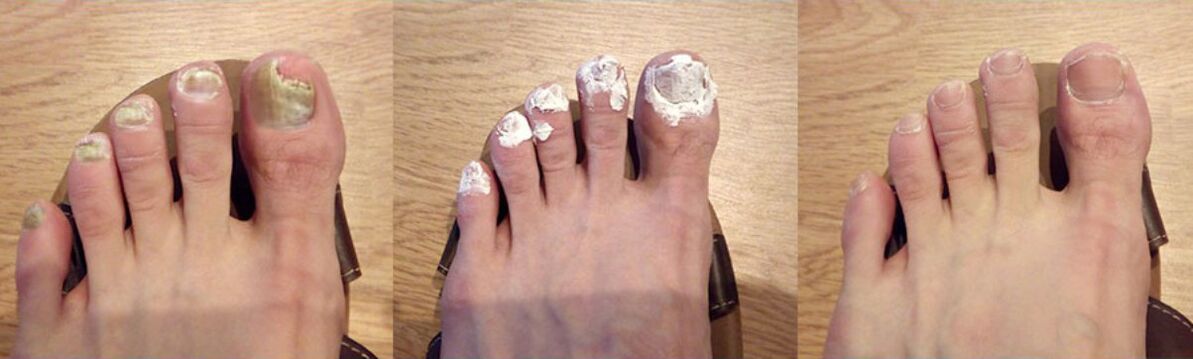 Το αποτέλεσμα της θεραπείας του μανιταριού με ραδιόφωνο