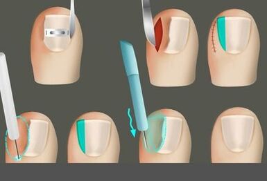 Αφαίρεση του καρφιού παρουσία μανιταριού στα πόδια