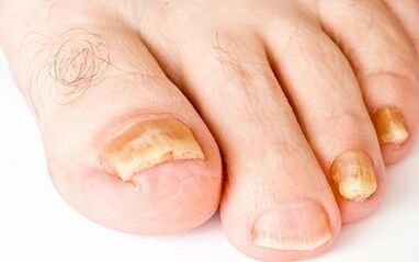 Φωτογραφικά συμπτώματα μύκητα νυχιών