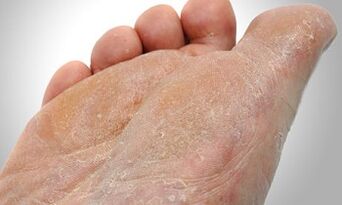 Μονοπάτια μετάδοσης μανιταριών ποδιών